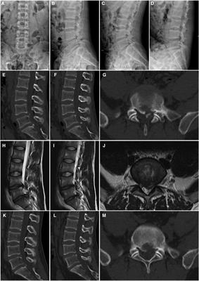 Percutaneous endoscopic lumbar discectomy as a treatment for lumbar disc herniation linked with posterior ring apophysis separation